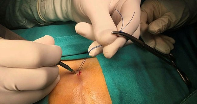 Lazerlə Pilonidal Sinus Əməliyyatı 