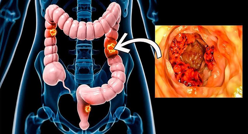 Qalın bağırsaq xərçəngi