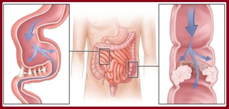 Bağırsaq Keçməzliyi (İleus)