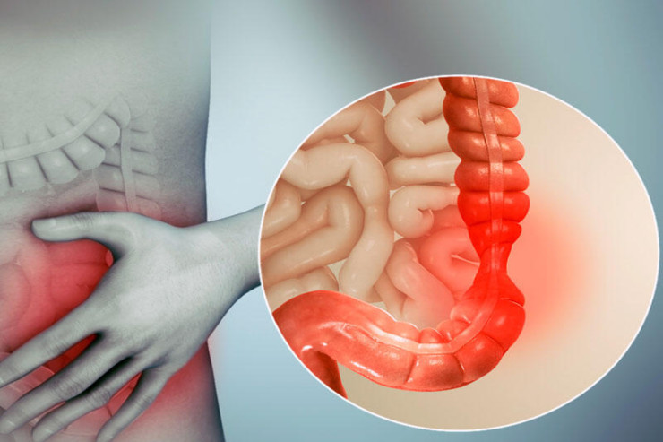 Düz Bağırsaq Xərçəngi