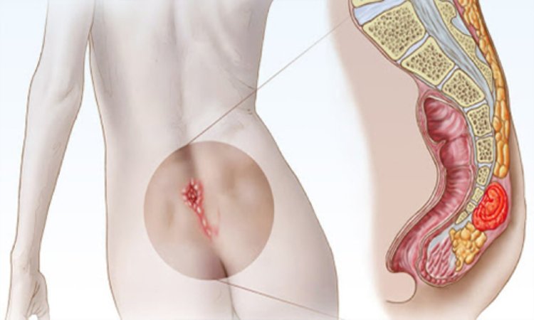 Lazerlə Pilonidal Sinus 