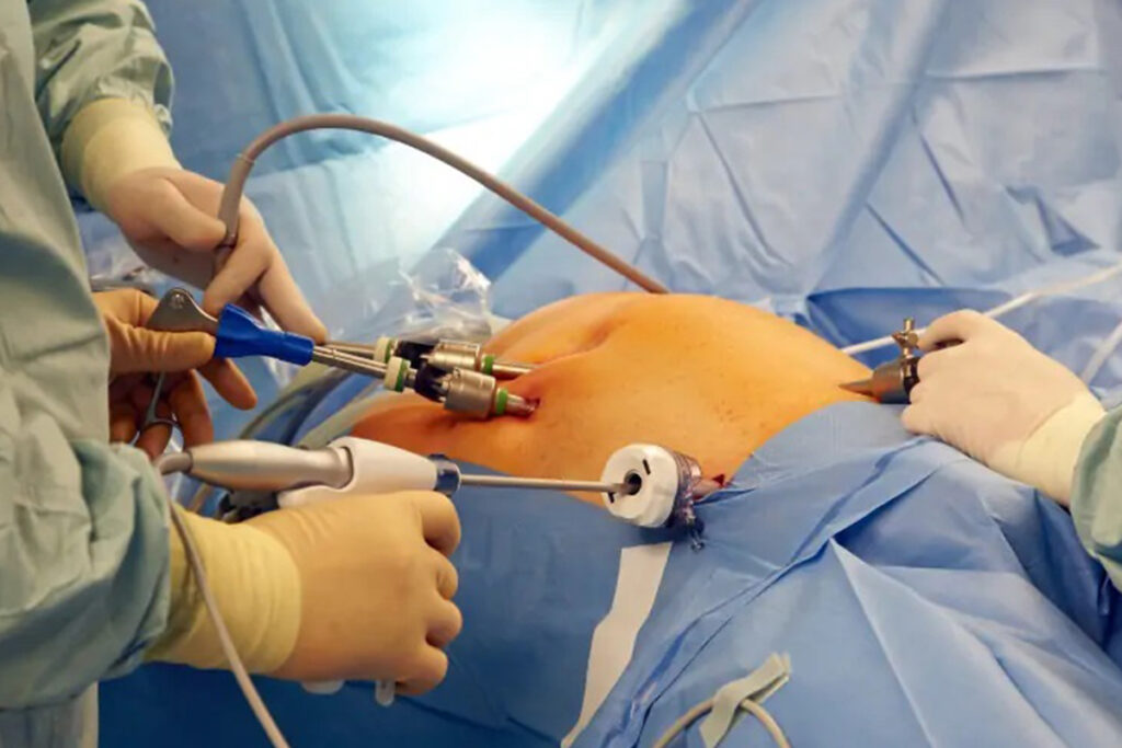 HIPEC Cərrahiyyəsi